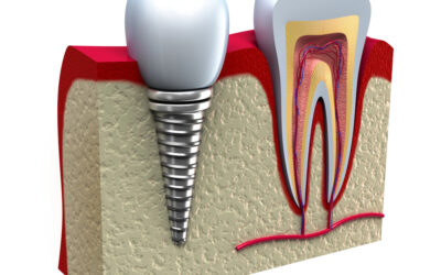 Caring for Your Dental Implants: Tips for Long-Lasting Results