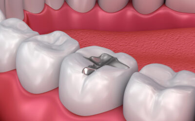 Choosing the Right Teeth Fillings: A Guide to Materials and Longevity