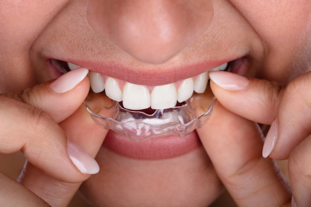 Teeth Whitening and Orthodontics: How to Brighten Your Smile with Braces or Aligners