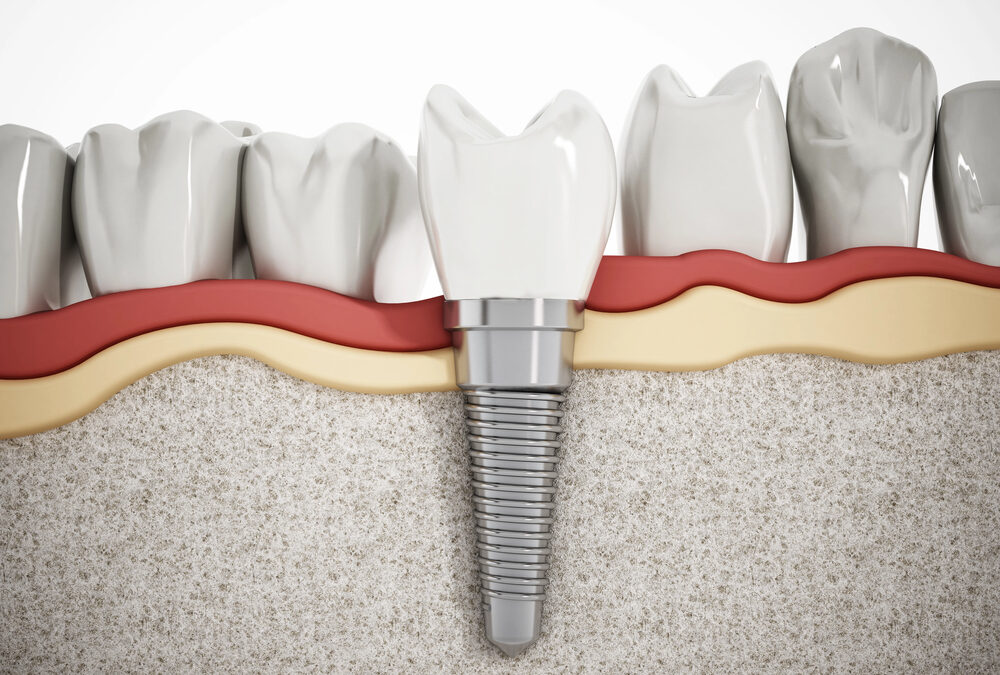 How Dental Implants Can Help Prevent Premature Aging