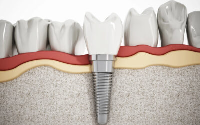 How Dental Implants Can Help Prevent Premature Aging